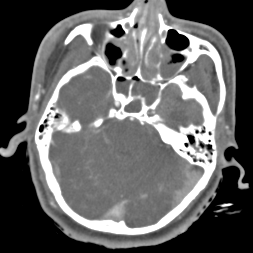 File:Brain contusions, internal carotid artery dissection and base of skull fracture (Radiopaedia 34089-35339 D 39).png