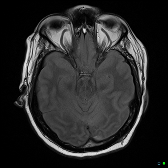 File:Brain death on MRI and CT angiography (Radiopaedia 42560-45689 Axial FLAIR 7).jpg