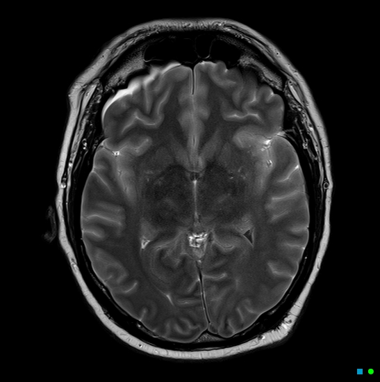 File:Brain death on MRI and CT angiography (Radiopaedia 42560-45689 Axial T2 16).jpg