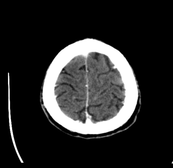 File:Brain metastases from lung cancer (Radiopaedia 24480-24781 Axial C+ delayed 56).jpg
