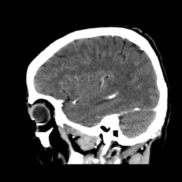Brain metastases from lung cancer (Radiopaedia 24480-24781 C+ delayed 16).jpg