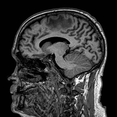 Brain metastases from lung cancer (Radiopaedia 83839-99028 Sagittal T1 74).jpg