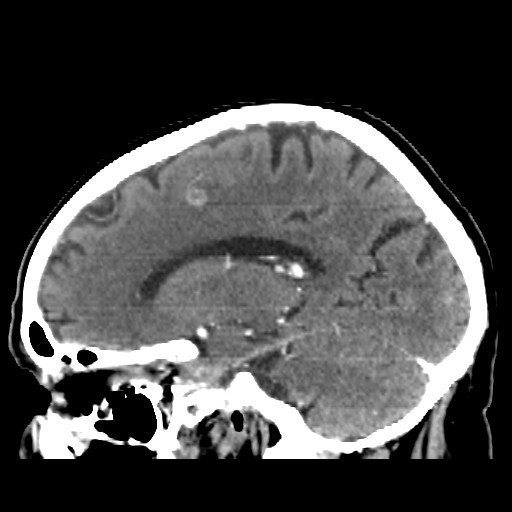 Brain metastasis (Radiopaedia 42617-45760 D 20).jpg