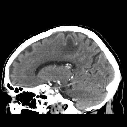 Brain metastasis (Radiopaedia 42617-45760 D 33).jpg
