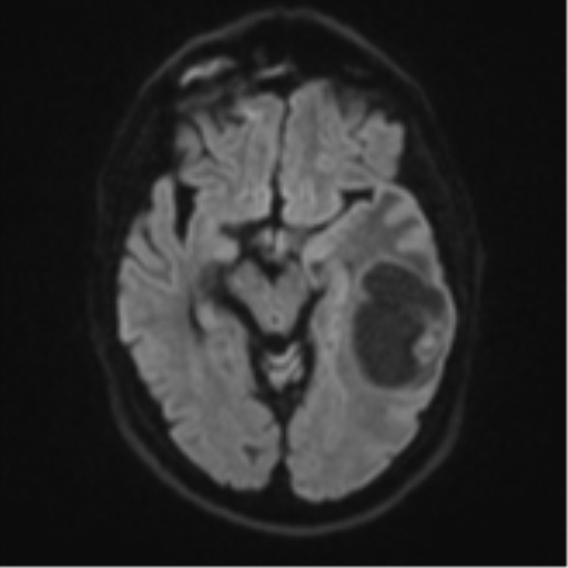 File:Brain metastasis (large cystic mass) (Radiopaedia 47497-52107 Axial DWI 39).png