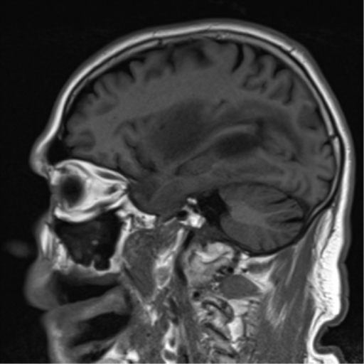 File:Brain metastasis (large cystic mass) (Radiopaedia 47497-52107 Sagittal T1 10).png