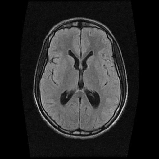 File:Brainstem glioma (Radiopaedia 30923-31624 Axial FLAIR 13).jpg