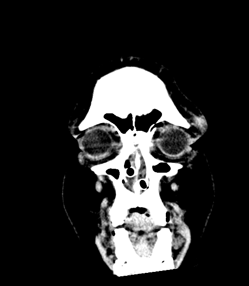Brainstem hemorrhage (Radiopaedia 81294-94976 Coronal non-contrast 6).jpg