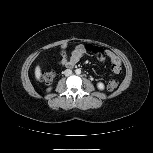 File:Breast cancer pseudocirrhosis after chemotherapy (Radiopaedia 65407-74456 A 47).jpg