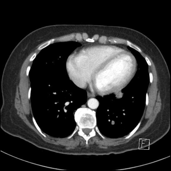 File:Breast metastases from renal cell cancer (Radiopaedia 79220-92225 A 64).jpg
