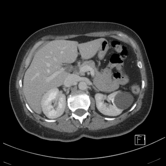 Breast metastases from renal cell cancer (Radiopaedia 79220-92225 C 30).jpg