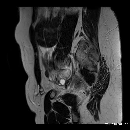File:Broad ligament fibroid (Radiopaedia 49135-54241 Sagittal T2 6).jpg