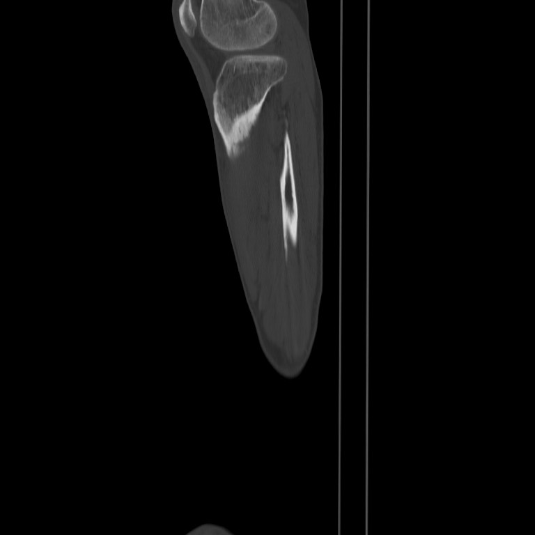 Brodie abscess - tibia (Radiopaedia 66028-75204 Sagittal bone window 66).jpg