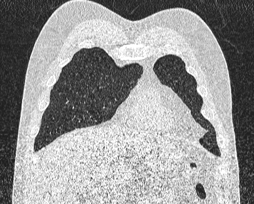 Bronchial atresia (Radiopaedia 58271-65417 Coronal lung window 8).jpg