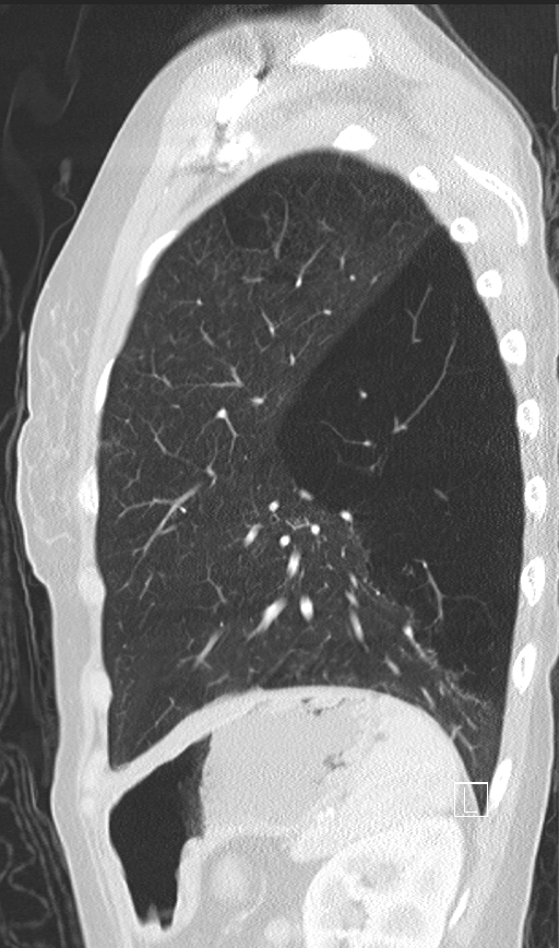Bronchial atresia (Radiopaedia 73677-84470 Sagittal lung window 42).jpg