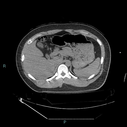 Bronchial carcinoid tumor (Radiopaedia 78272-90870 Axial non-contrast 108).jpg