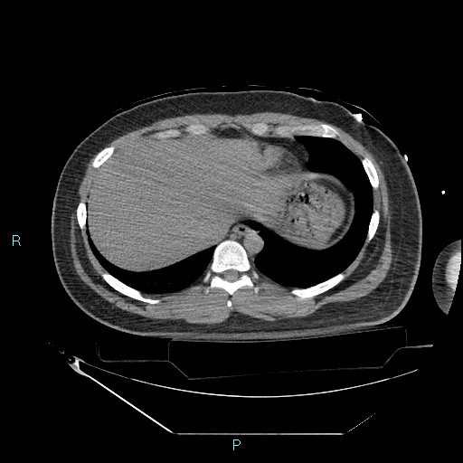 Bronchial carcinoid tumor (Radiopaedia 78272-90870 Axial non-contrast 87).jpg