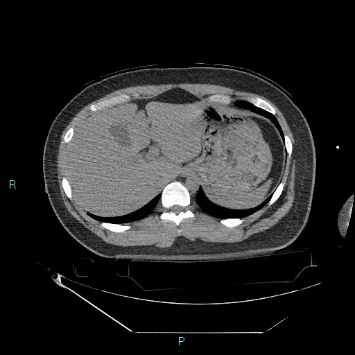 Bronchial carcinoid tumor (Radiopaedia 78272-90870 Axial non-contrast 98).jpg