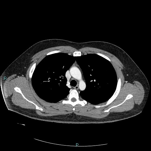 Bronchial carcinoid tumor (Radiopaedia 78272-90875 A 36).jpg