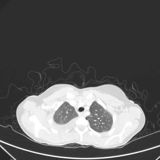 Bronchial mucoepidermoid carcinoma (Radiopaedia 57023-63895 Axial lung window 16).jpg