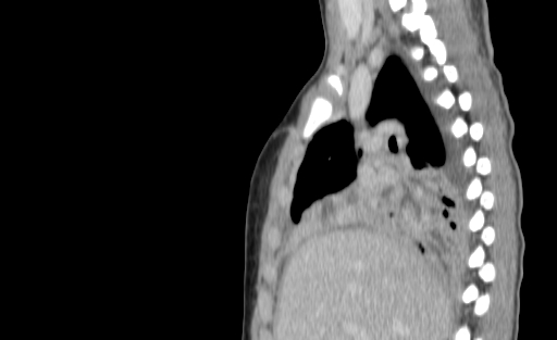 Bronchial mucoepidermoid carcinoma (Radiopaedia 57023-63895 Sagittal 81).jpg