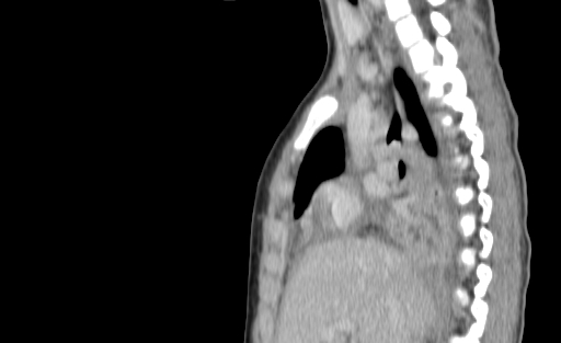 Bronchial mucoepidermoid carcinoma (Radiopaedia 57023-63895 Sagittal 92).jpg