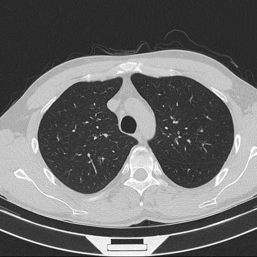 Bronchocele (Radiopaedia 60676-68429 Axial lung window 19).jpg