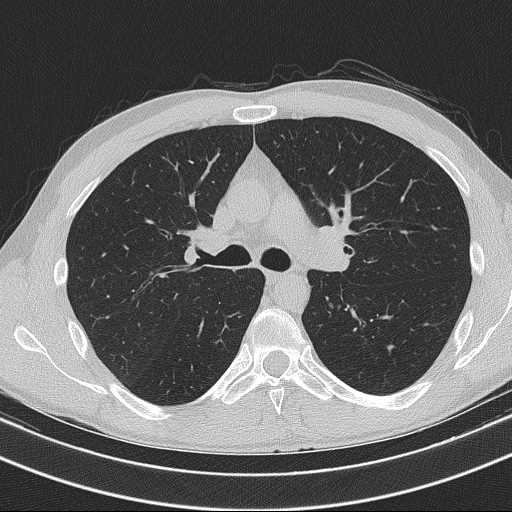 Bronchocele (Radiopaedia 60676-68429 Axial lung window 28).jpg