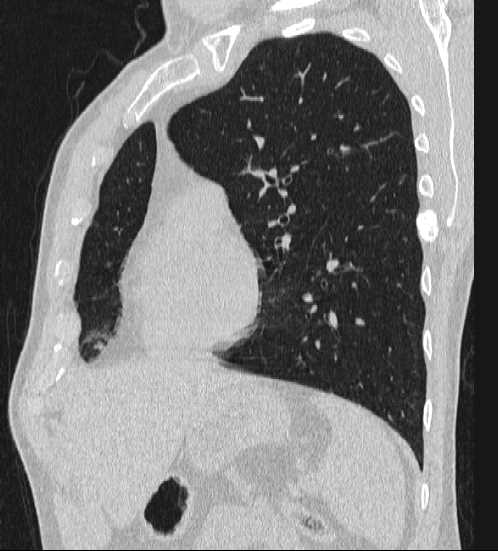 File:Bronchocele (Radiopaedia 60676-68429 Oblique lung window 3).jpg