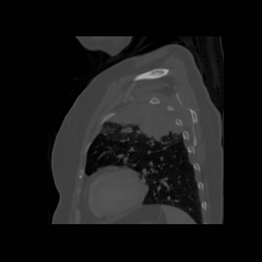 File:Bronchogenic carcinoma (Radiopaedia 73497-84262 Sagittal bone window 118).jpg