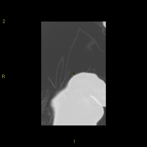 File:Bronchogenic carcinoma as an incidental finding (Radiopaedia 16453-16130 Coronal lung window 6).jpg