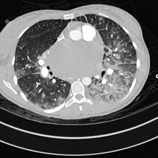 Bronchogenic cyst (Radiopaedia 77801-90071 Axial lung window 38).jpg