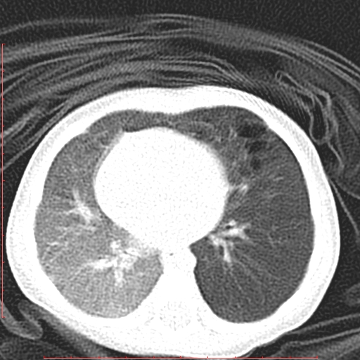 File:Bronchogenic cyst (Radiopaedia 78599-91409 Axial lung window 87).jpg