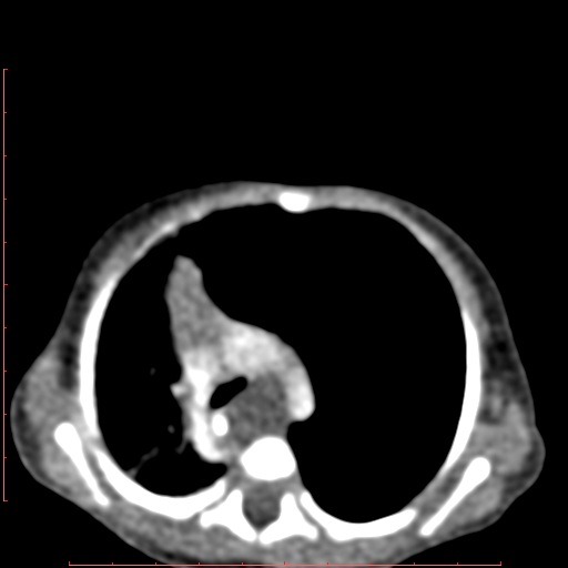 Bronchogenic cyst (Radiopaedia 78599-91409 B 84).jpg