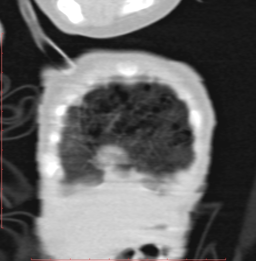 Bronchogenic cyst (Radiopaedia 78599-91409 Coronal lung window 25).jpg
