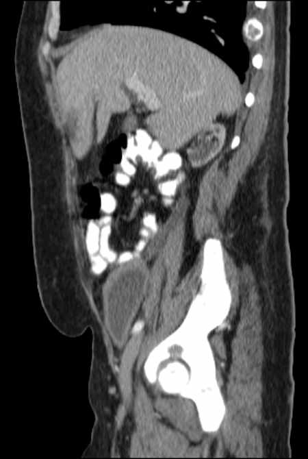 Brown tumors compressing the spinal cord (Radiopaedia 68442-77988 F 19).jpg