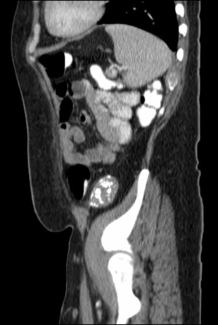 Brown tumors compressing the spinal cord (Radiopaedia 68442-77988 F 44).jpg