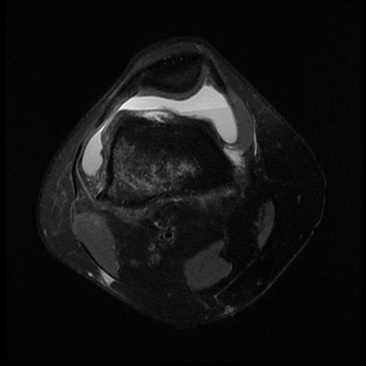 File:Bucket handle meniscus tear (Radiopaedia 56916-63751 Axial PD fat sat 3).jpg