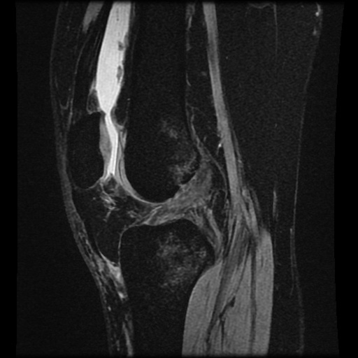 File:Bucket handle meniscus tear (Radiopaedia 56916-63751 H 40).jpg