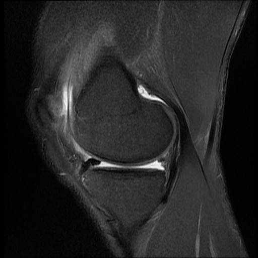 File:Bucket handle tear - medial meniscus (Radiopaedia 69245-79026 Sagittal PD fat sat 13).jpg