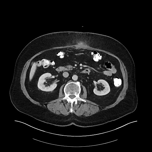 Buried bumper syndrome - gastrostomy tube (Radiopaedia 63843-72575 A 34).jpg