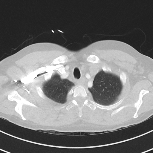 Burkitt lymphoma (Radiopaedia 34686-36121 Axial lung window 8).png