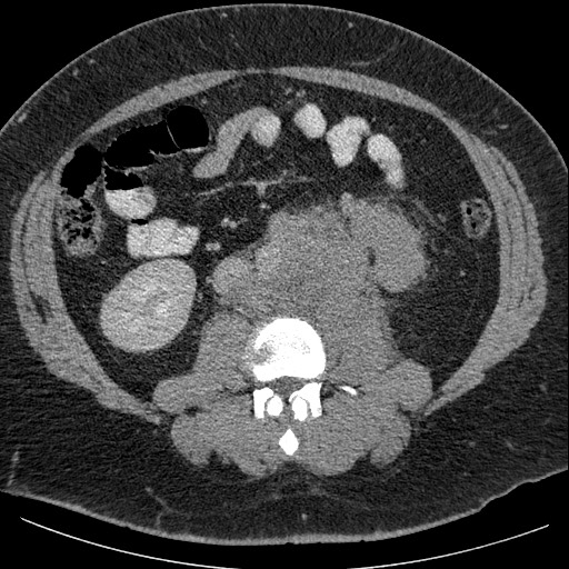 Burned-out testicular seminoma - retroperitoneal nodal metastases (Radiopaedia 62872-71245 A 39).jpg