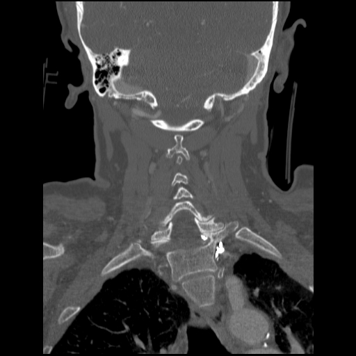 File:C1 anterior arch (plough) fracture - type 1 (Radiopaedia 76181-87720 Coronal bone window 36).jpg