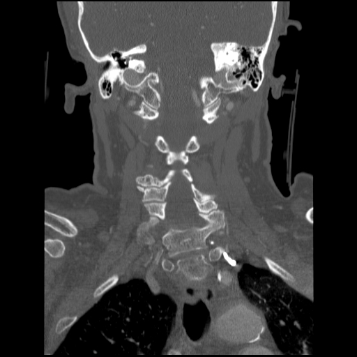 File:C1 anterior arch (plough) fracture - type 1 (Radiopaedia 76181-87720 Coronal bone window 44).jpg