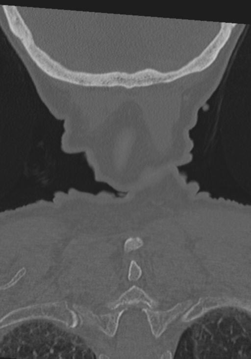 C2 fracture with vertebral artery dissection (Radiopaedia 37378-39199 Coronal bone window 55).png