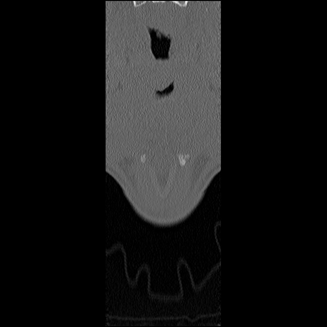 C5 facet fracture (Radiopaedia 58374-65499 Coronal bone window 4).jpg