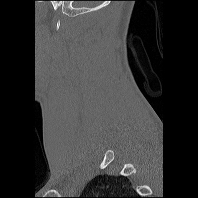 C5 facet fracture (Radiopaedia 58374-65499 Sagittal bone window 57).jpg