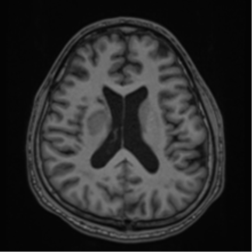 CNS vasculitis (Radiopaedia 55715-62263 Axial T1 45).png