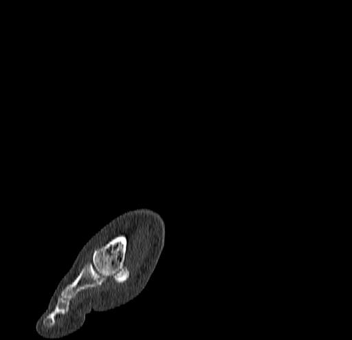 File:Calcaneal fracture - Sanders type 4 (Radiopaedia 90179-107370 Sagittal bone window 12).jpg
